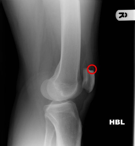 Missed Diagnosis of Enthesitis Related Arthritis