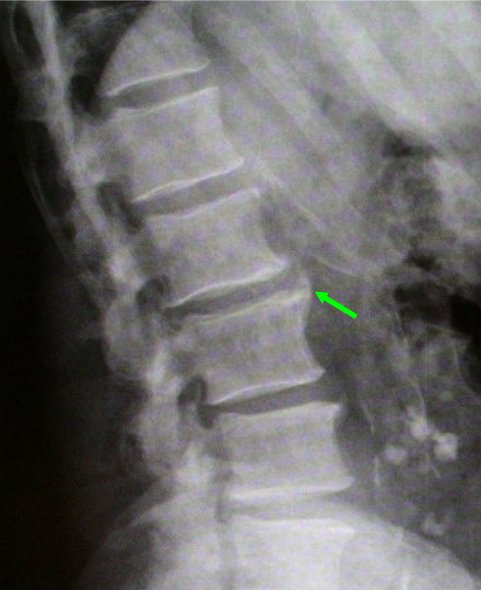 cervical spine arthritis x ray