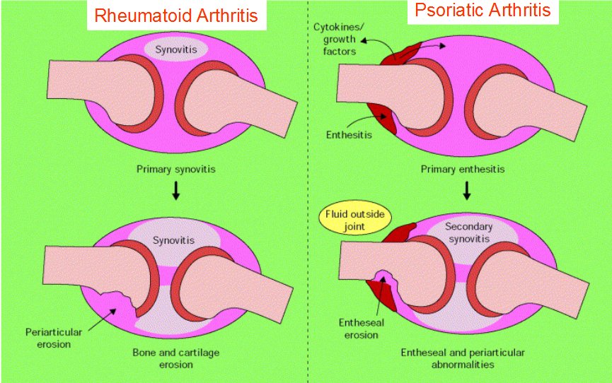 psoriatic arthritis thesis