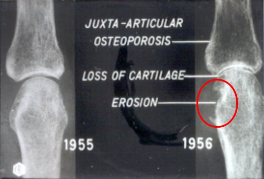 The Enthesis and Bone Erosion in Rheumatoid Arthritis