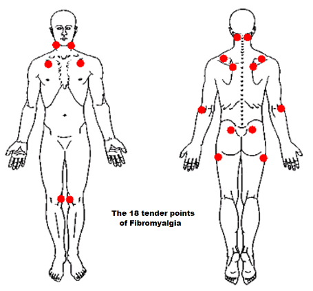 Fibromyalgia Points Tenderness Chart